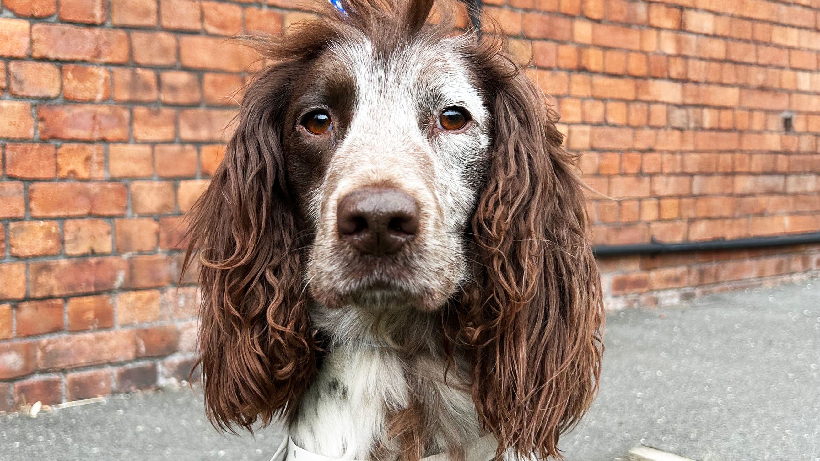 Agatha: Surgical Management of Humeral Bicondylar Fracture